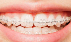 clear braces